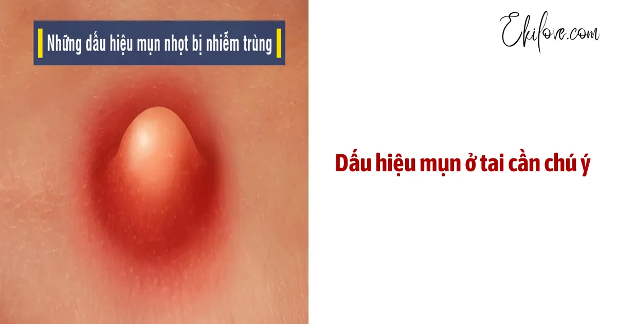 Dấu Hiệu Mụn Ở Tai Cần Chú Ý